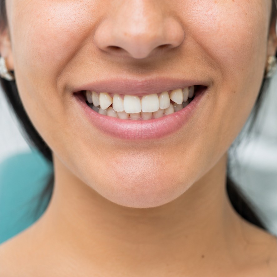 Sonrisa antes del tratamiento